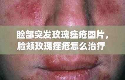 脸部突发玫瑰痤疮图片,脸颊玫瑰痤疮怎么治疗