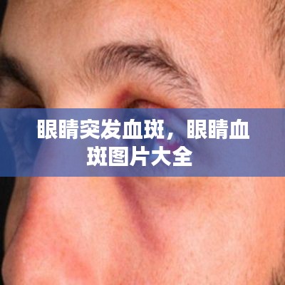 眼睛突发血斑,眼睛血斑图片大全